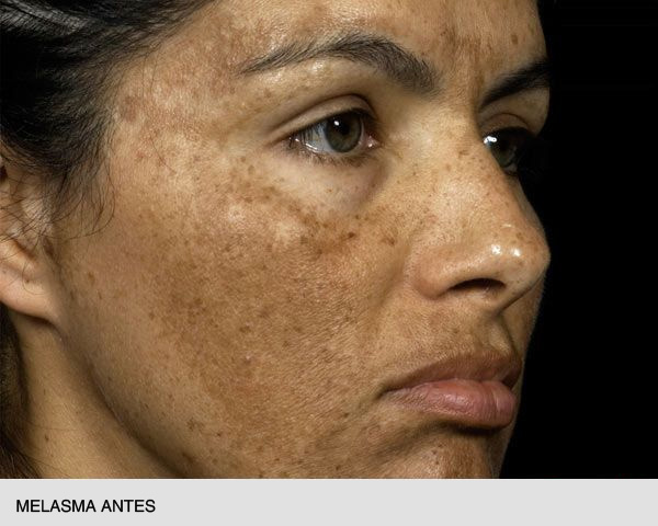 Fraxel melasma antes y después