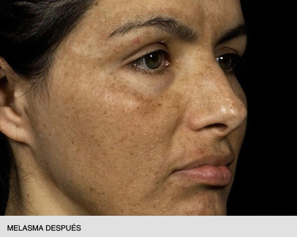 Fraxel melasma antes y después