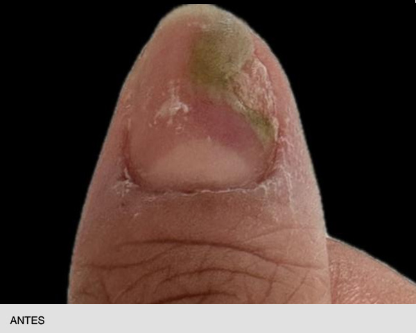Laser para hongos en-las-uñas antes y después