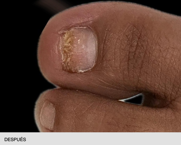 Laser para onicomicosis en las uñas antes y después