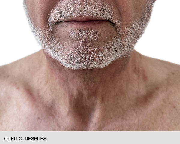 Endolift cuello antes después