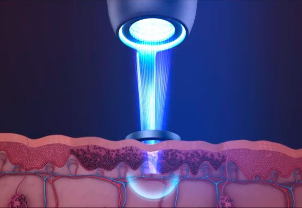 Laser picosegundos para cicatrices