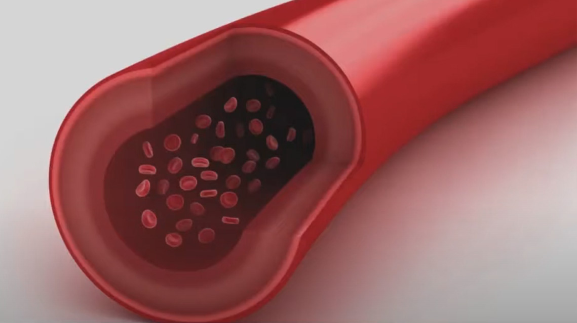 laáer vascular para cuperosis