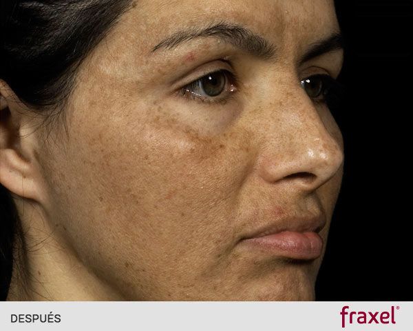 Eliminar melasma con Fraxel