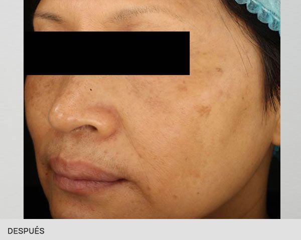 Eliminar melasma definitivamente