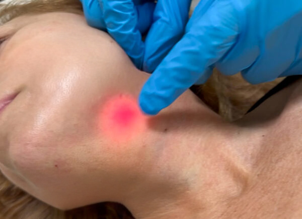 endolift facial